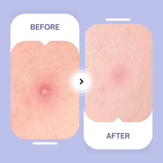 Spotted Nighttime - Patchs hydrocolloïdes originaux